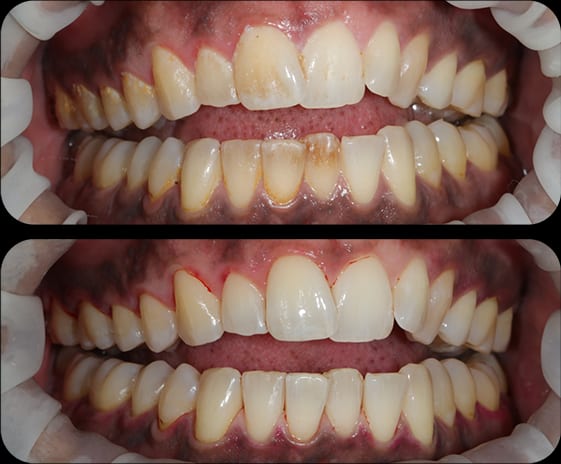 EMS before and after 1