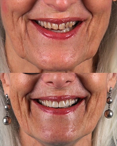 Veneers Smile Makeover 12