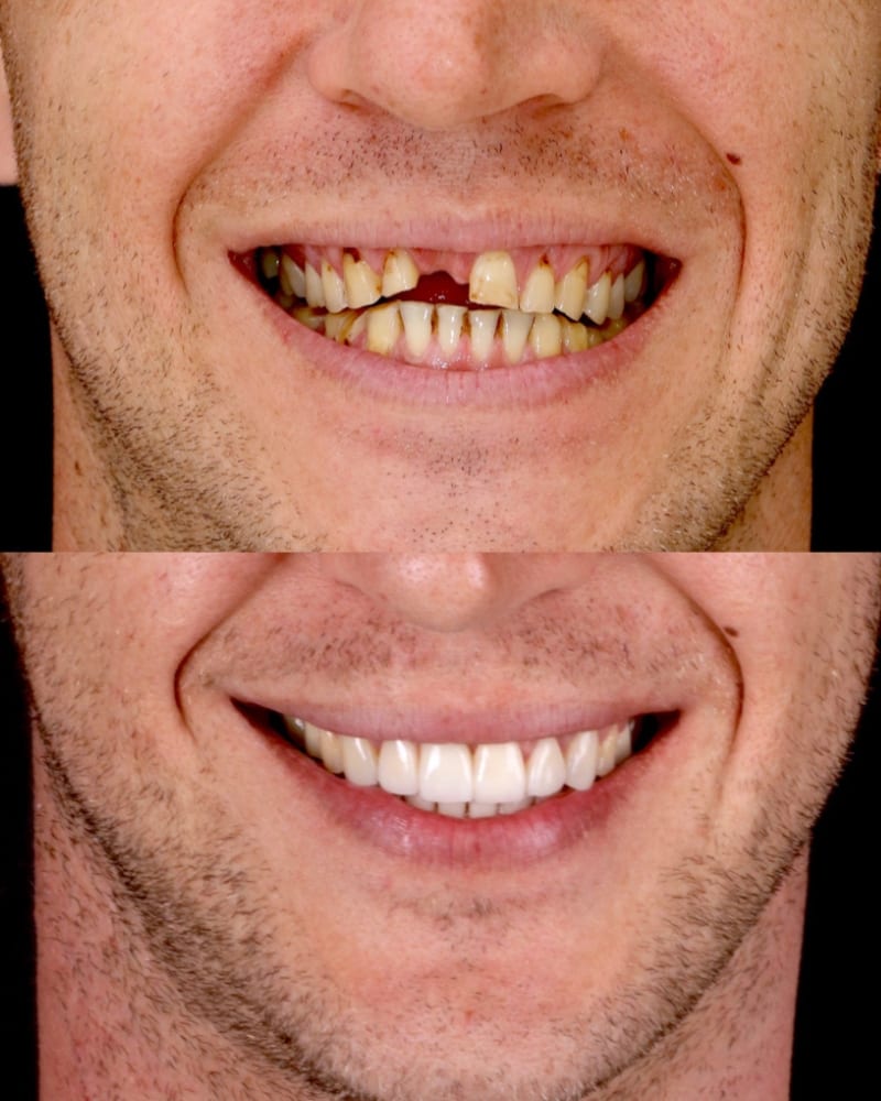 SVL before after 12