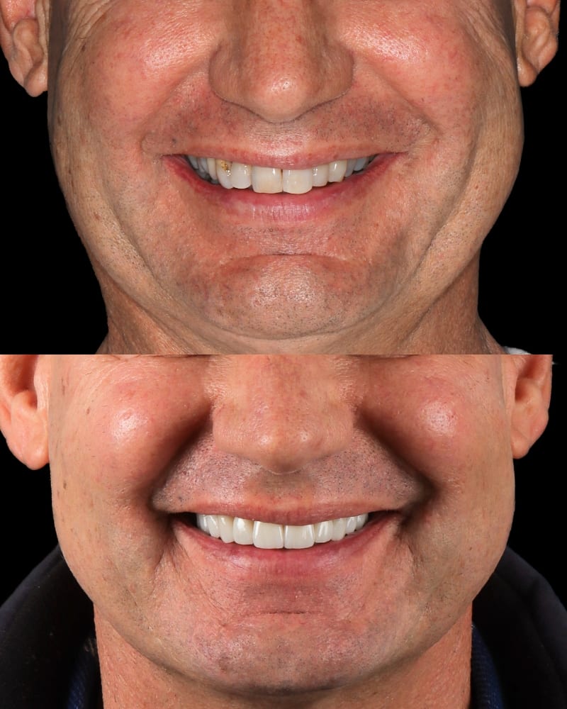 SVL before after 16