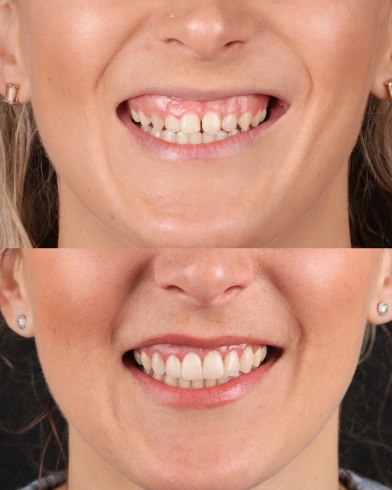 SVL before after 1
