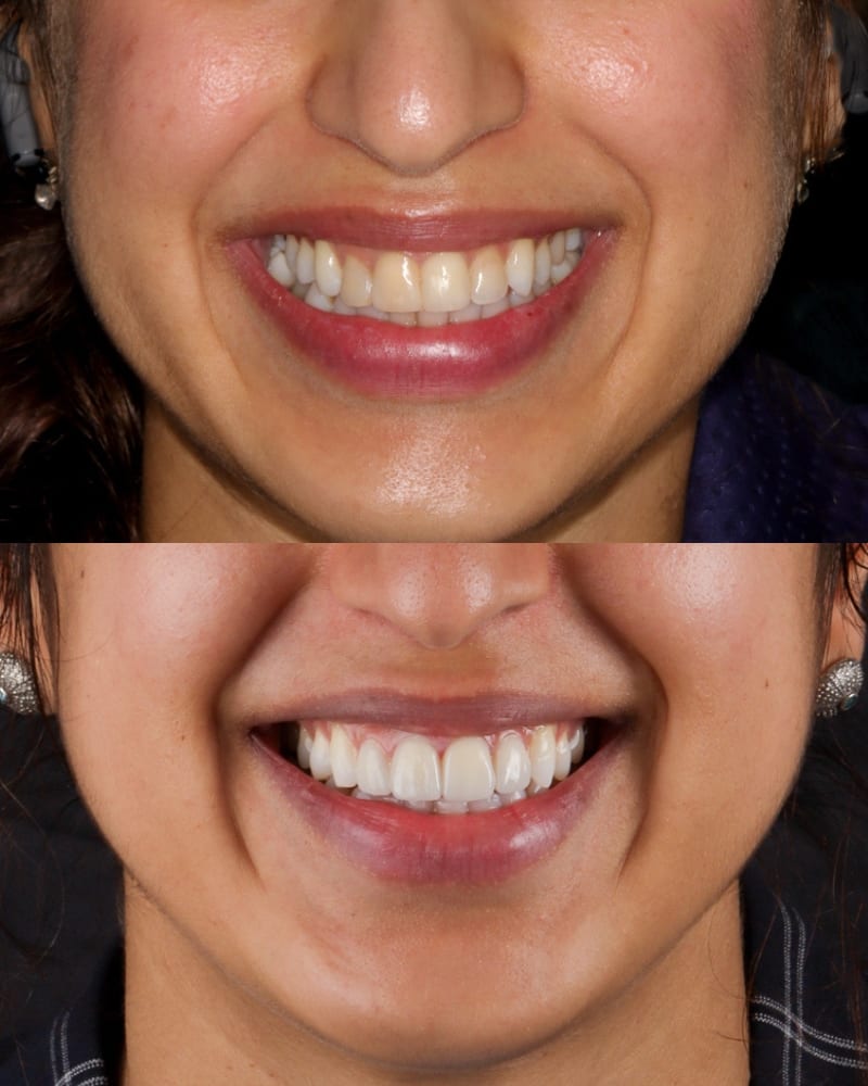 SVL before after 23