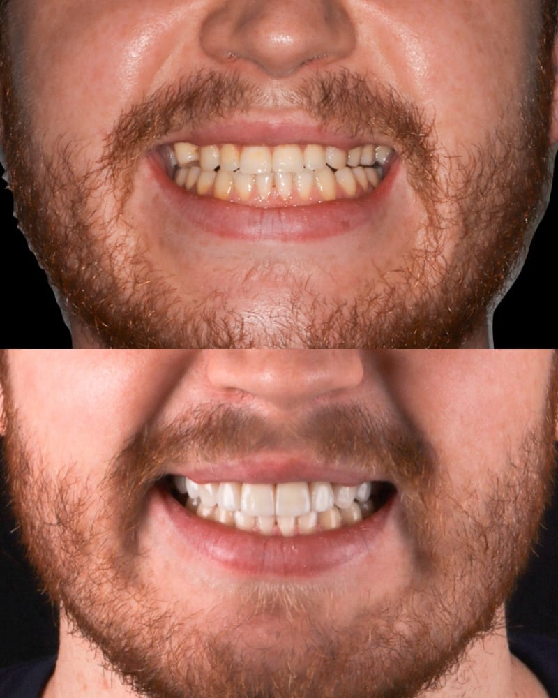 SVL before after 29
