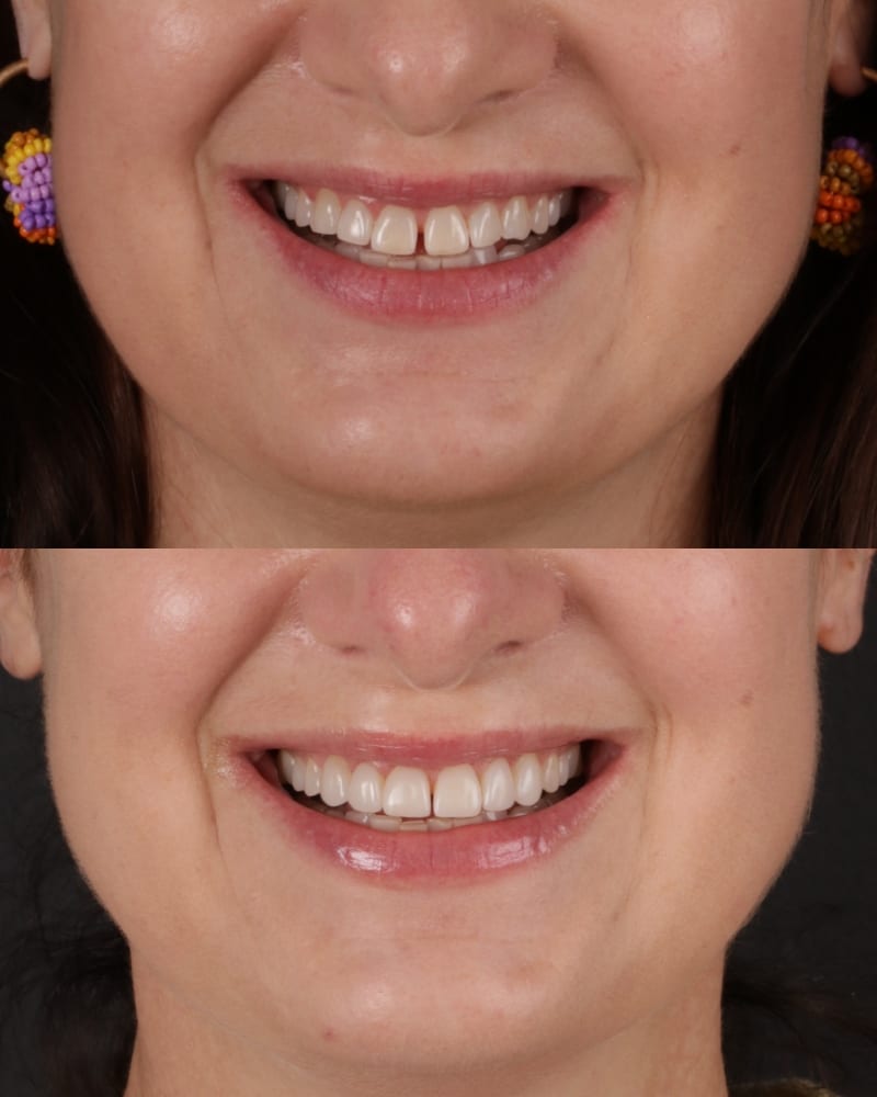 SVL before after 6