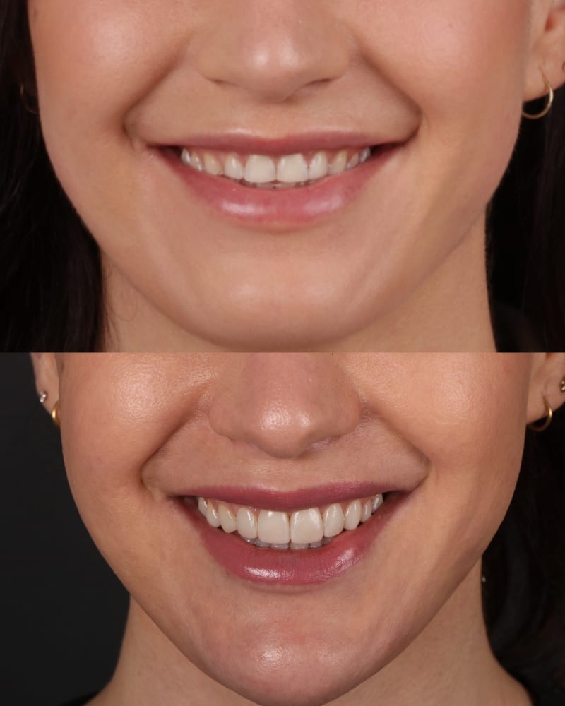 SVL before after 7