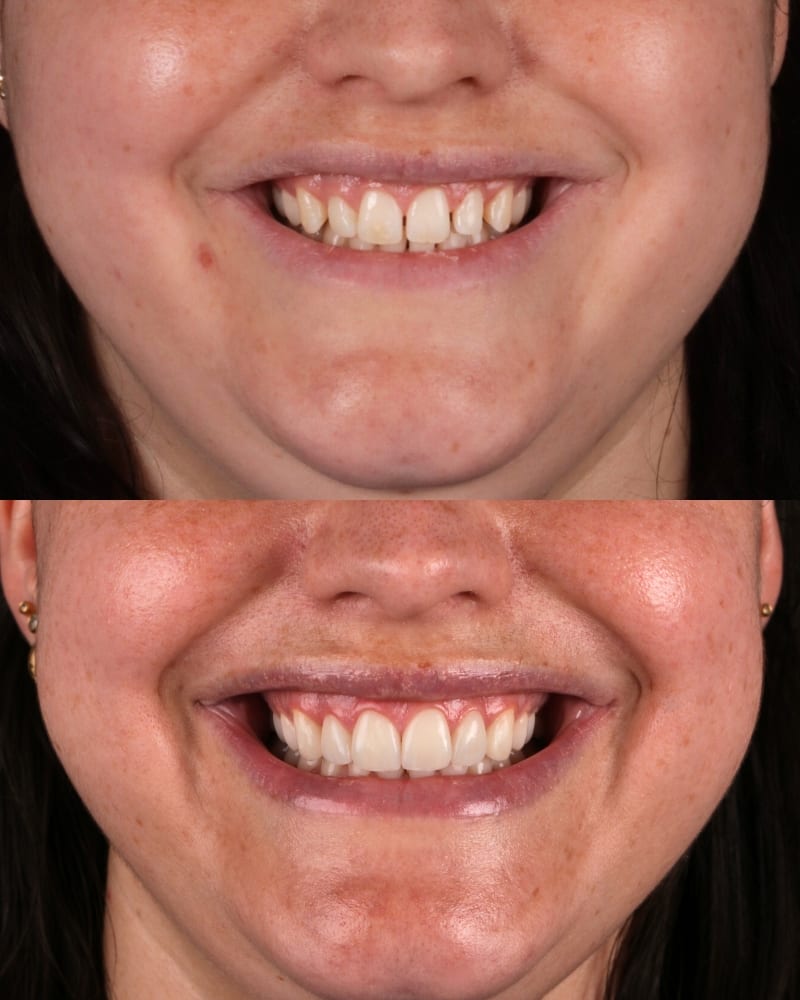 SVL before after 8