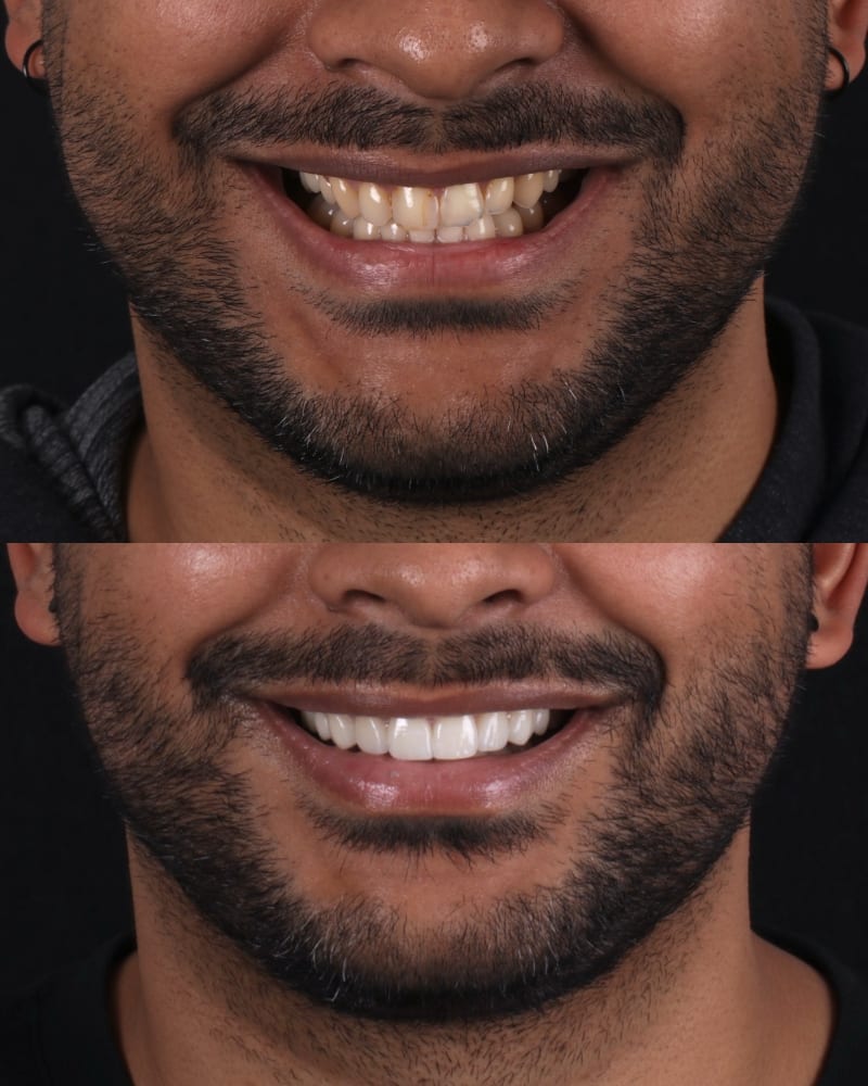SVL before after 9