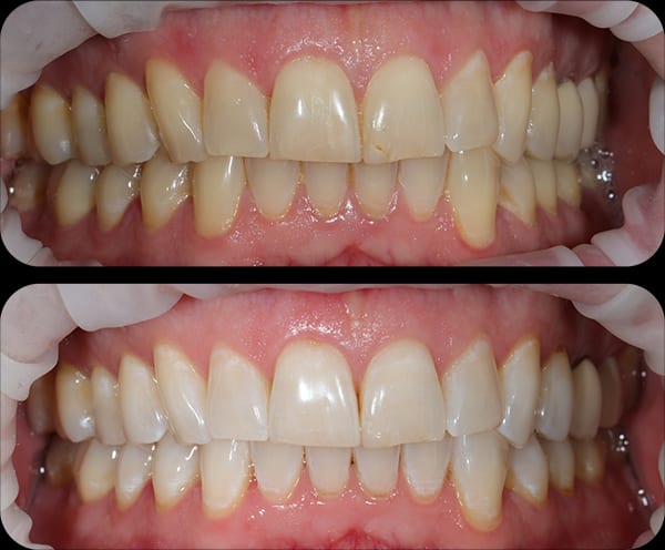 Whitening Before and After 2